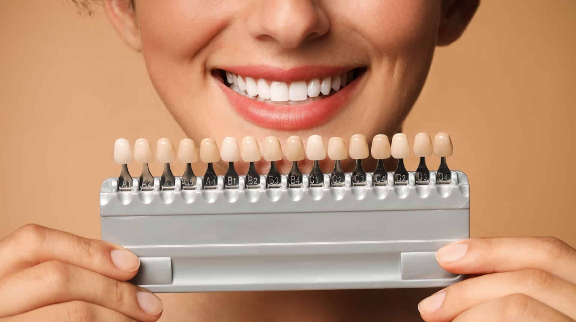 Dental Crowns vs Veneers NZ: Woman Holding Teeth Colour Samples to Mouth
